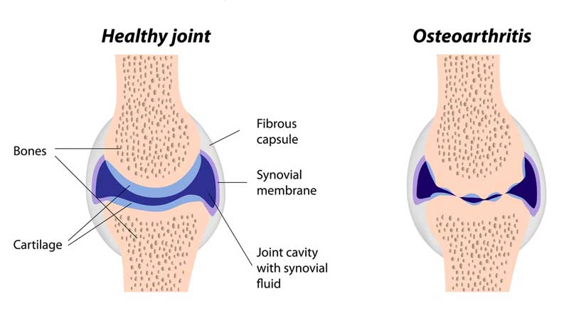 imbieras ir osteoartritas