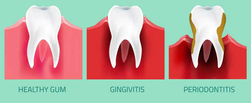 imbieras infekcijos gingvitas periodontitas